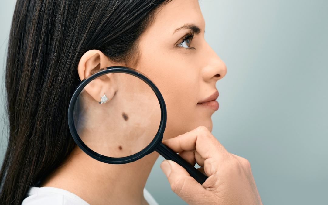 Skin Cancer Treatment Orland Park