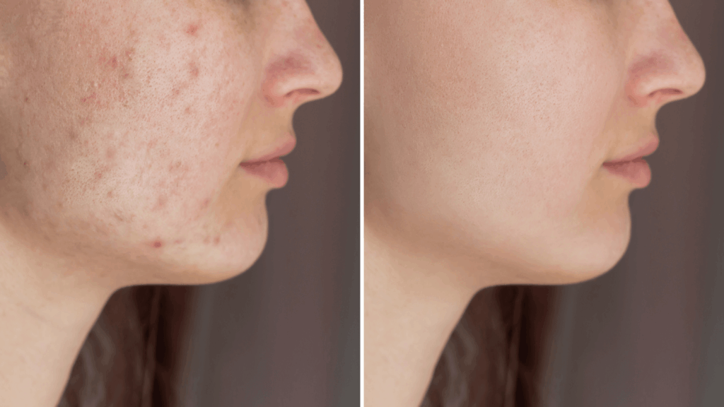 Can Fractora Treatment Help with Acne Scars?