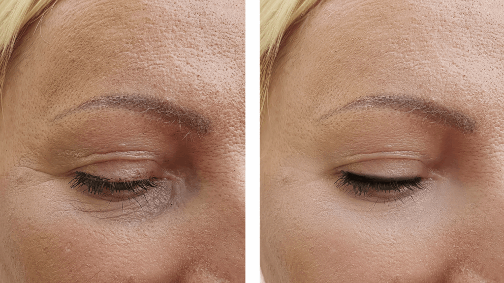 Fractora Recovery: What to Expect After Your Treatment