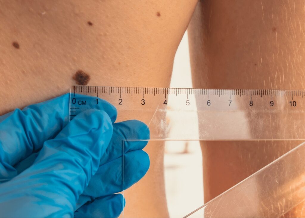 Dermatologist measuring mole with ruler during annual skin exam in New Lenox clinic