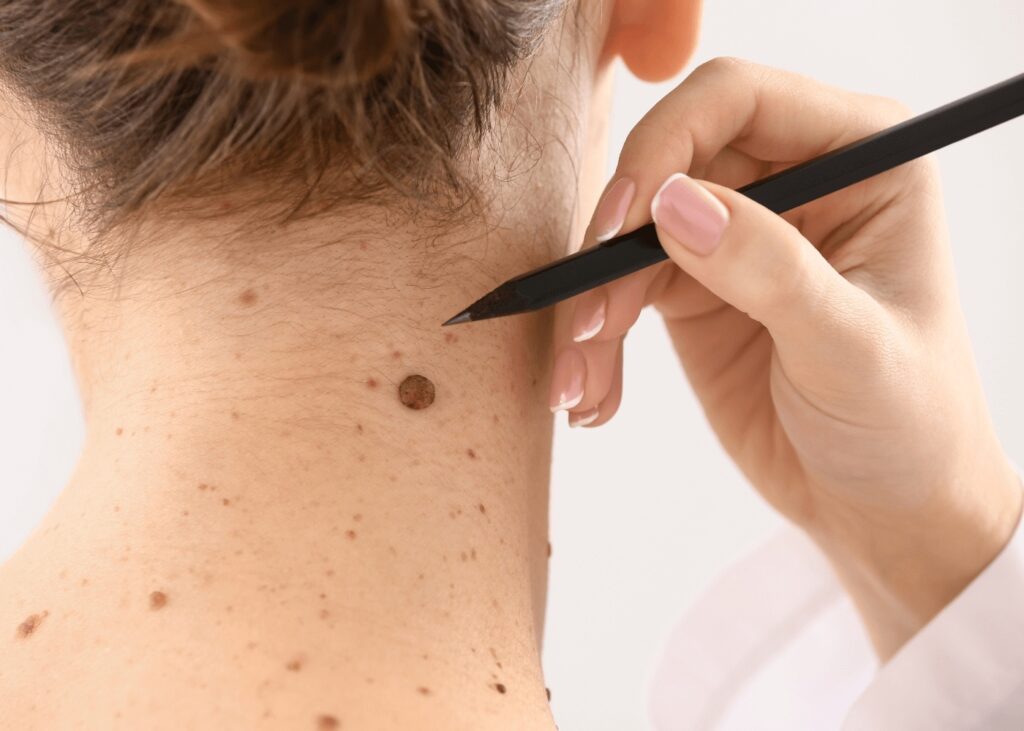 Why Your Annual Skin Exam New Lenox Matters More Than Ever